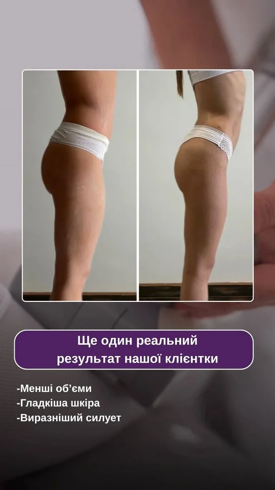 Корекція фігури результат — Enjoy Beauty