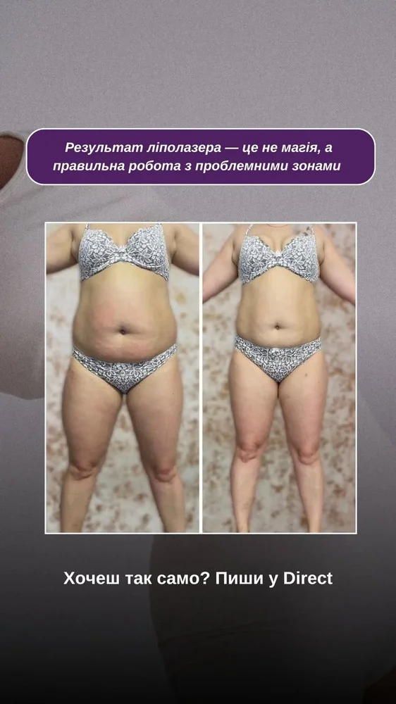 Корекція фігури результат — Enjoy Beauty