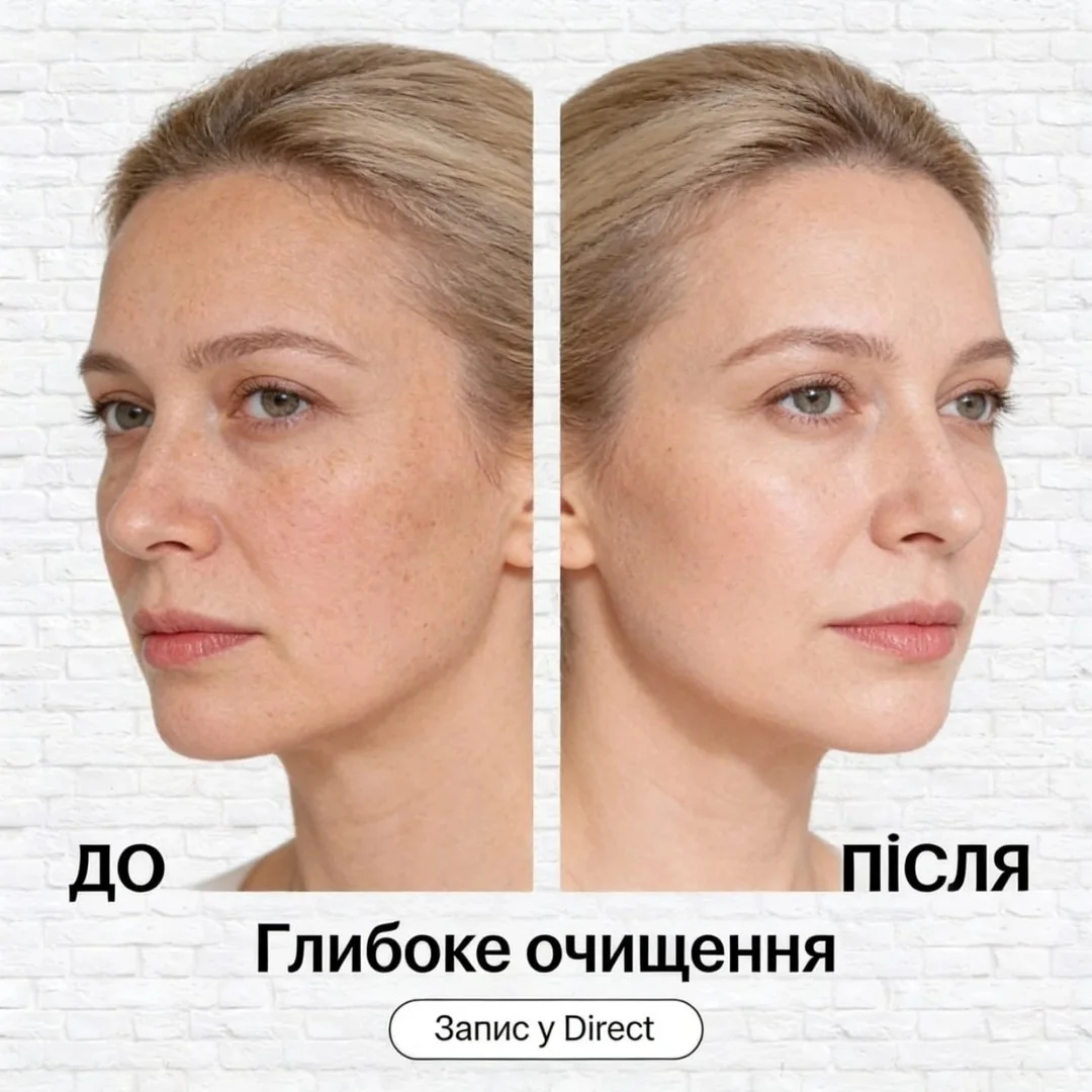 Чистка