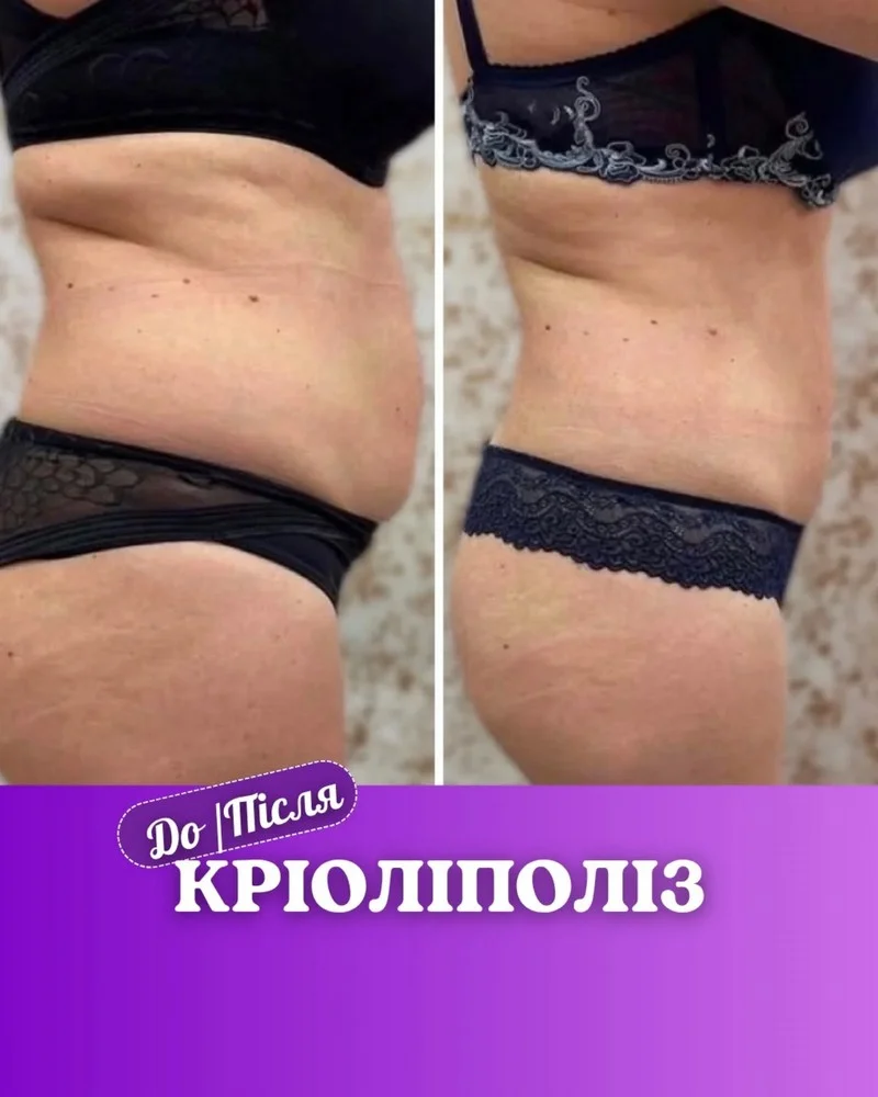 Результат до та після — Enjoy Beauty